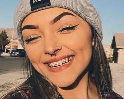 The star used braces to correct her teeth.